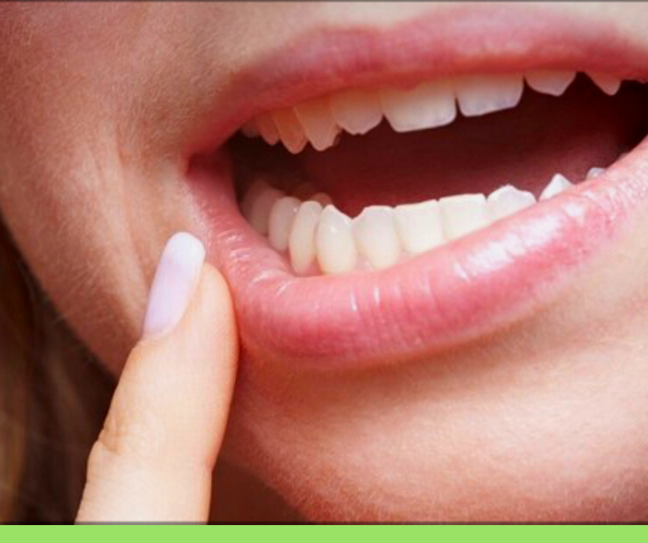 Oral Cancer Day: prevenire tramite autoanalisi del cavo orale.