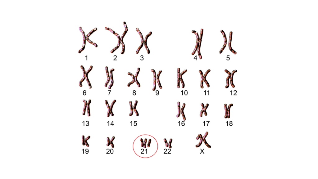 digramma della sindrome di down con cromosomi