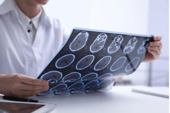Sclerosi multipla e maternità, neurologa Marfia: “Personalizzare percorso”