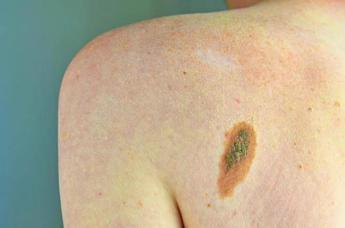 Melanoma, Adoi: “Bene nuova legge su prevenzione, dermatologo centrale in screening”